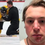 OS-stjärnans svar – visar upp skadan